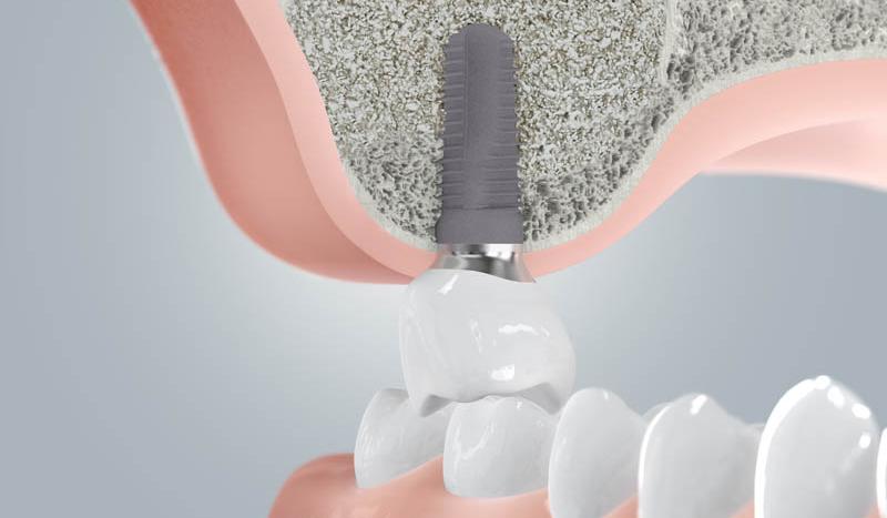 Implantatkrone nach Sinusbodenelevation