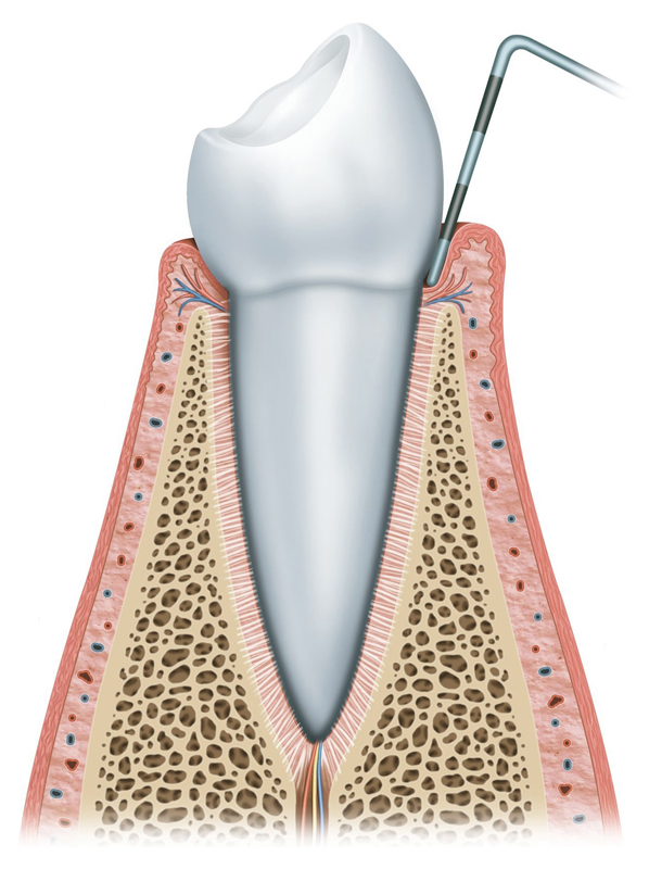 Parodontitistherapie